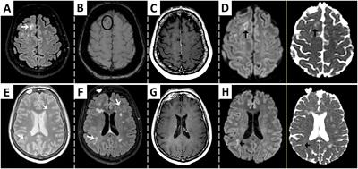 Elevation of serum neurofilament light-chain levels disclose possible occult progressive multifocal leukoencephalopathy and immune reconstitution syndrome in a patient receiving ozanimod: a case report